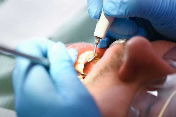 Best Dentist for Tooth Abscess  in Lyman, WY